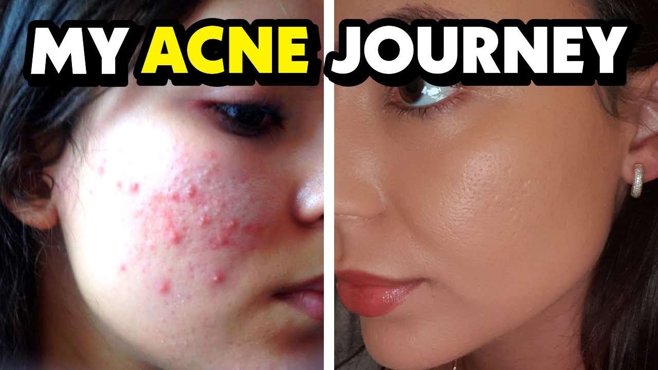 HOW I CURED MY ACNE WITH A MAGIC PILL