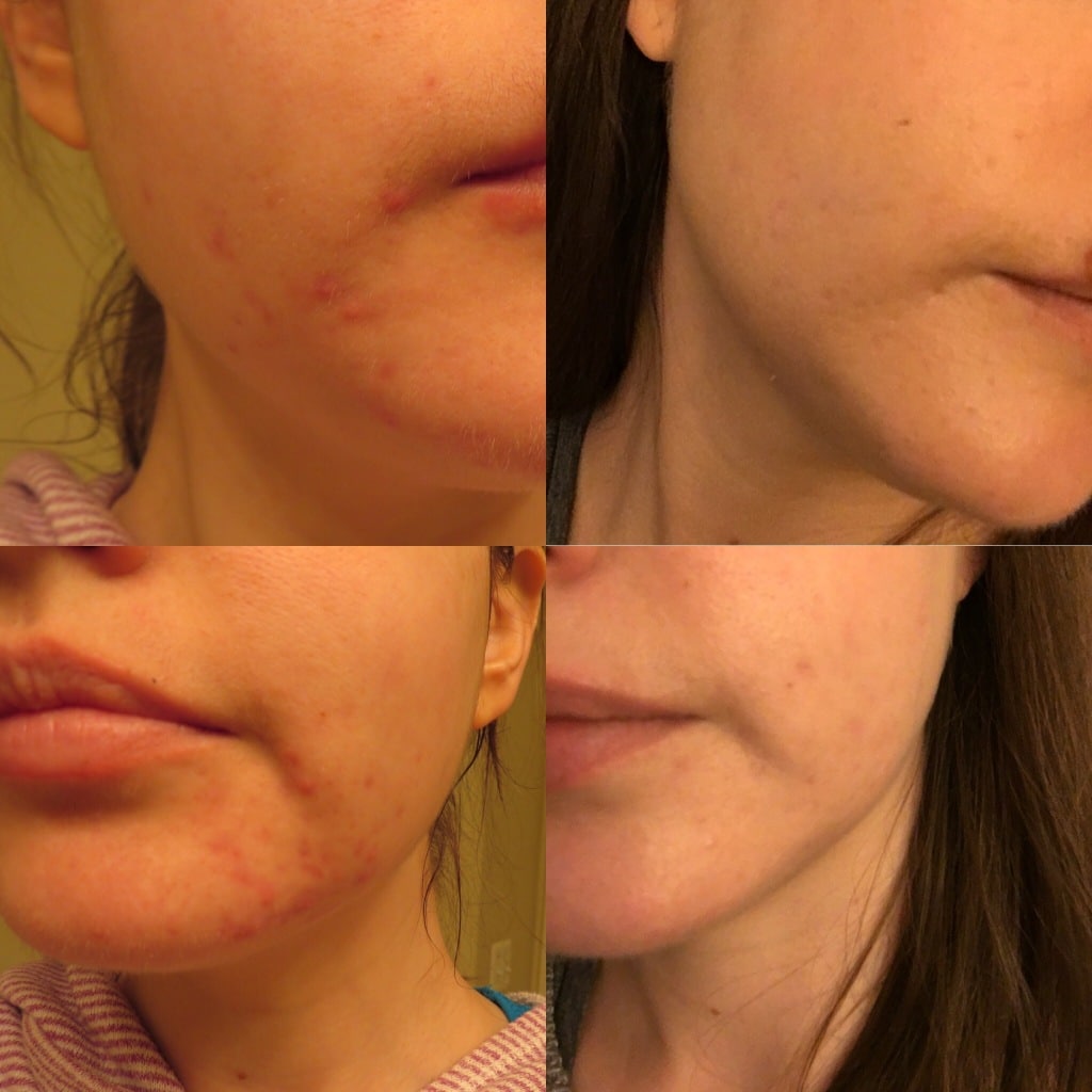 How I cured my hormonal acne  Flow with Carly