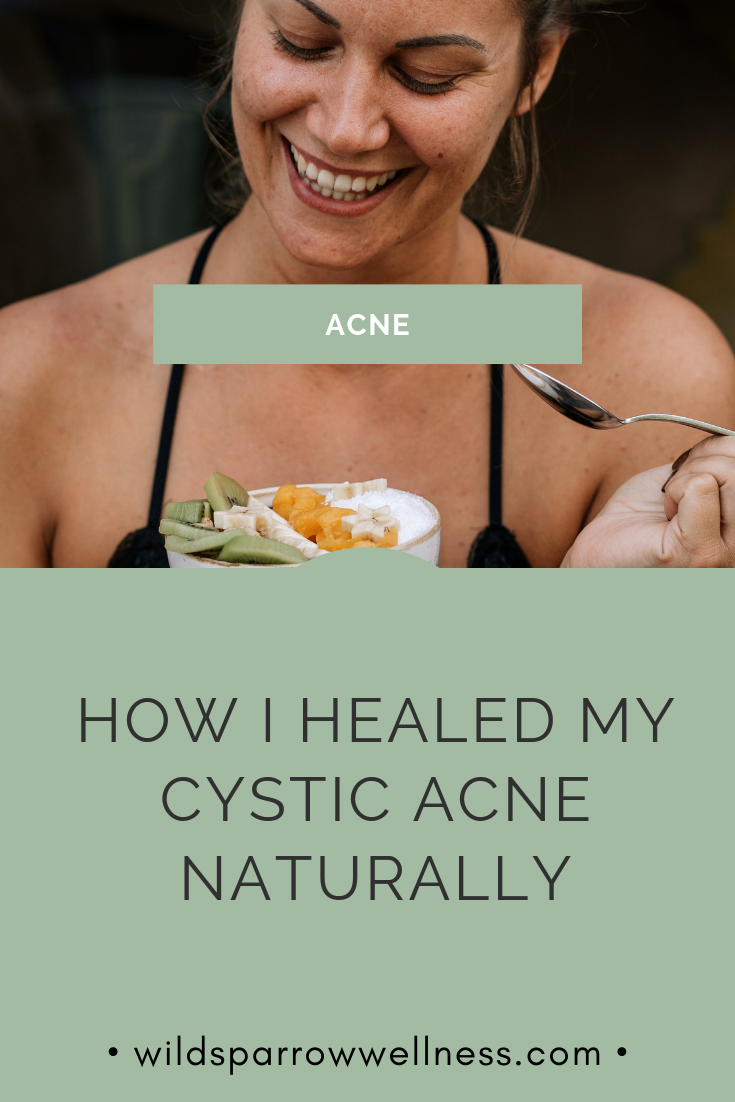 How I Healed My Hormonal Cystic Acne (Naturally)