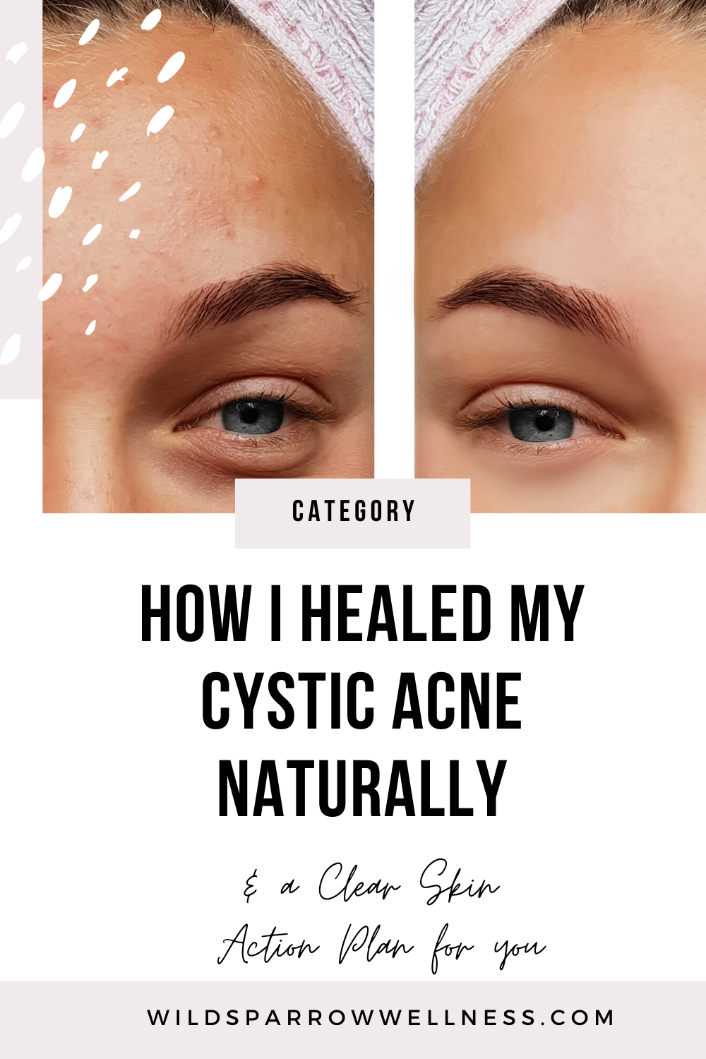 How I Healed My Hormonal Cystic Acne (Naturally) in 2020