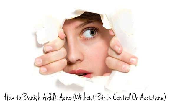 How to banish adult acne (without birth control or Accutane)