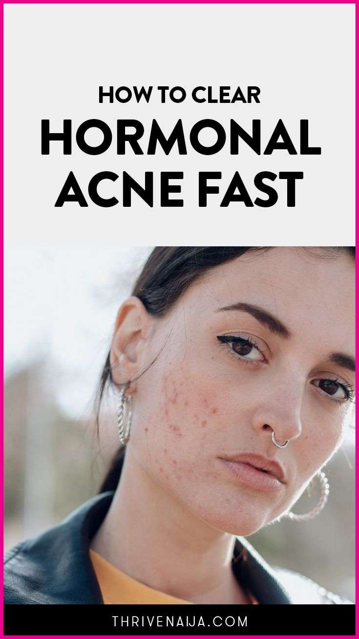 How to Clear Hormonal Acne Fast: Complete Guide