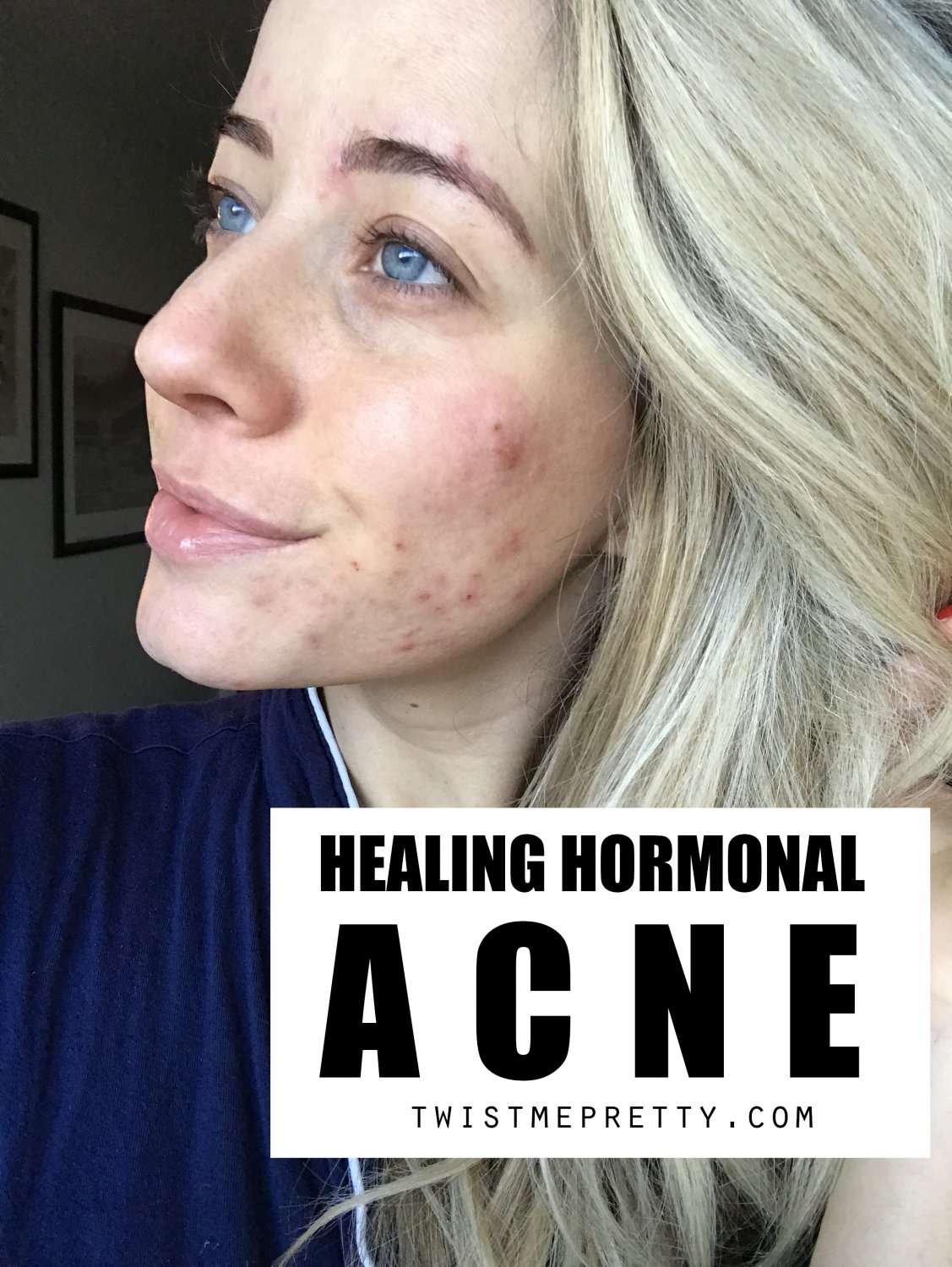 How To Clear Up Hormonal Acne + My Journey