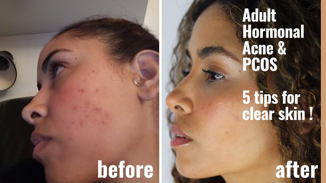 How To Cure Pcos Acne