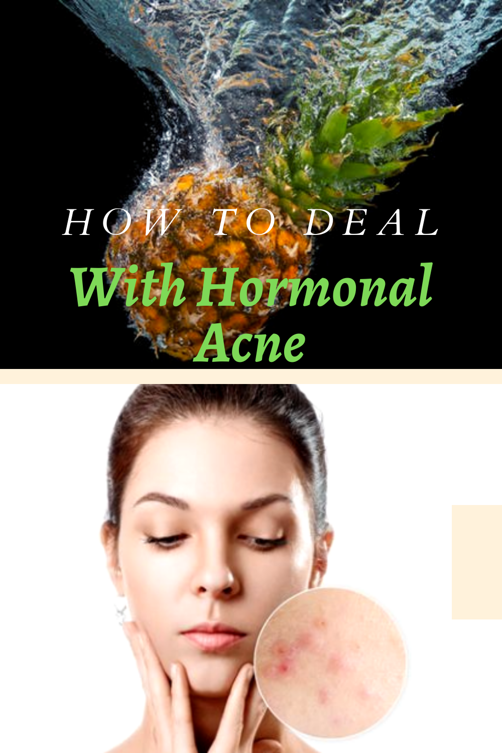 HOW TO DEAL WITH HORMONAL ACNE