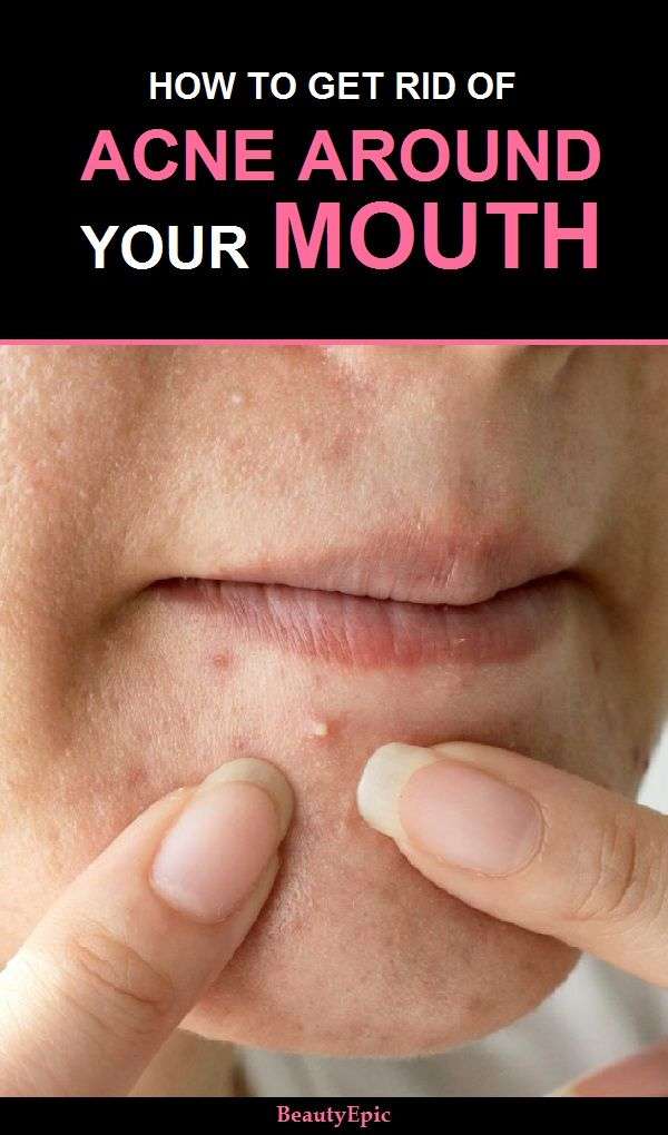 How to Get Rid of Acne Around Mouth?