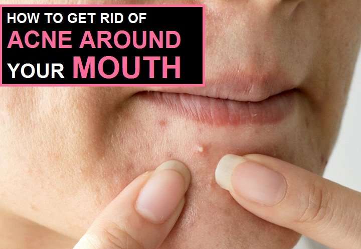 How to Get Rid of Acne Around Mouth?