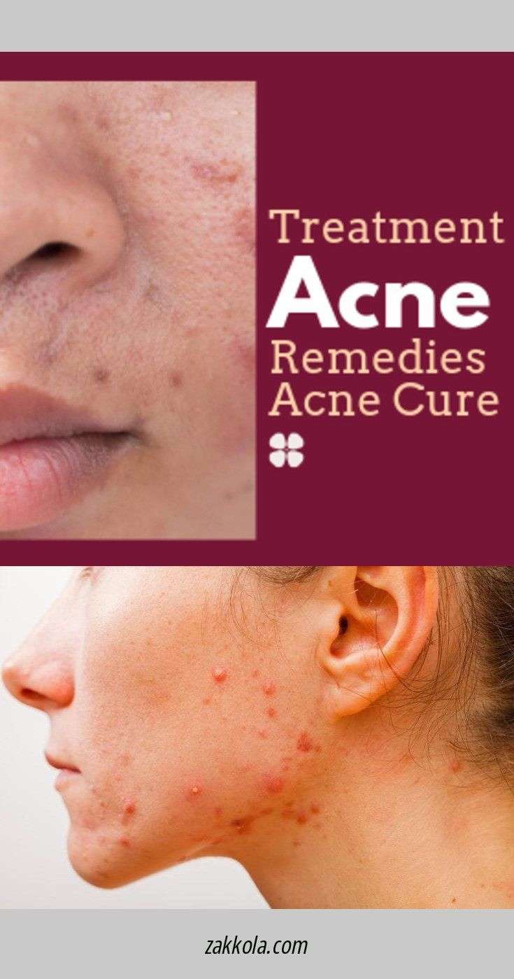 How To Get Rid Of Acne Caused By Birth Control