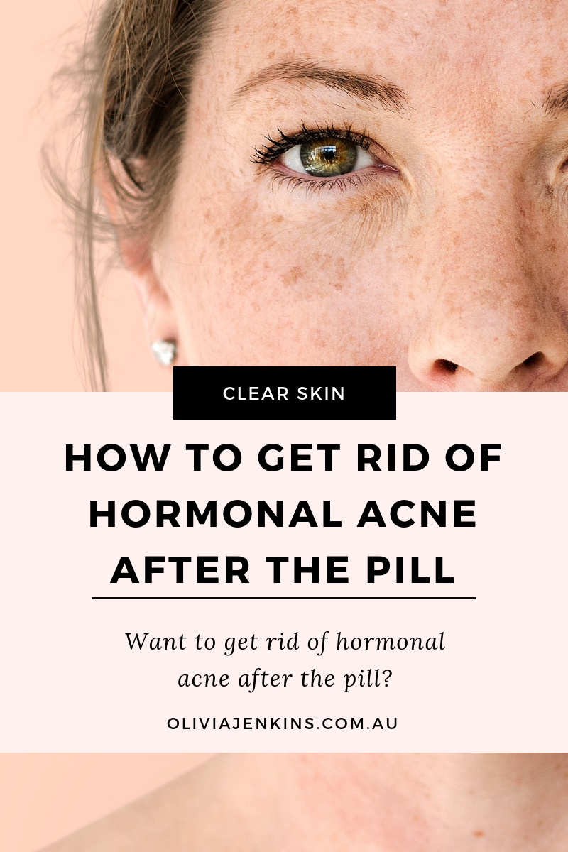 How To Get Rid Of Hormonal Acne After The Pill