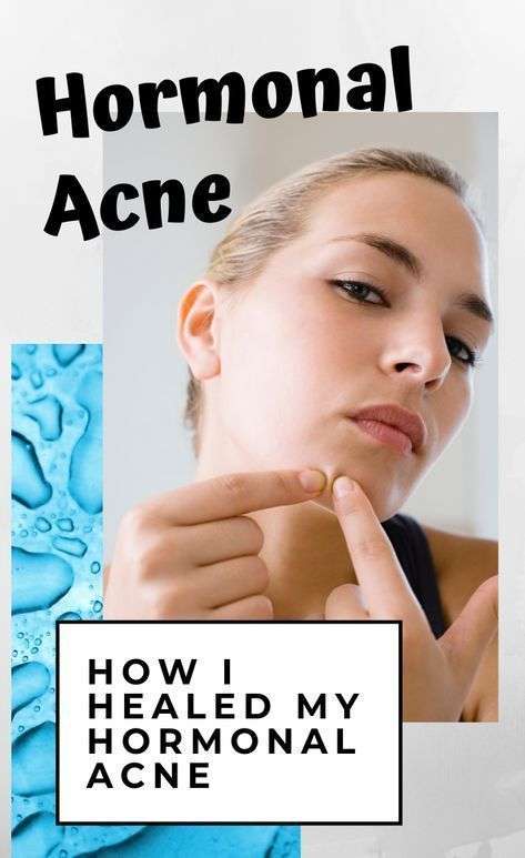 How to Get Rid of Hormonal Acne?