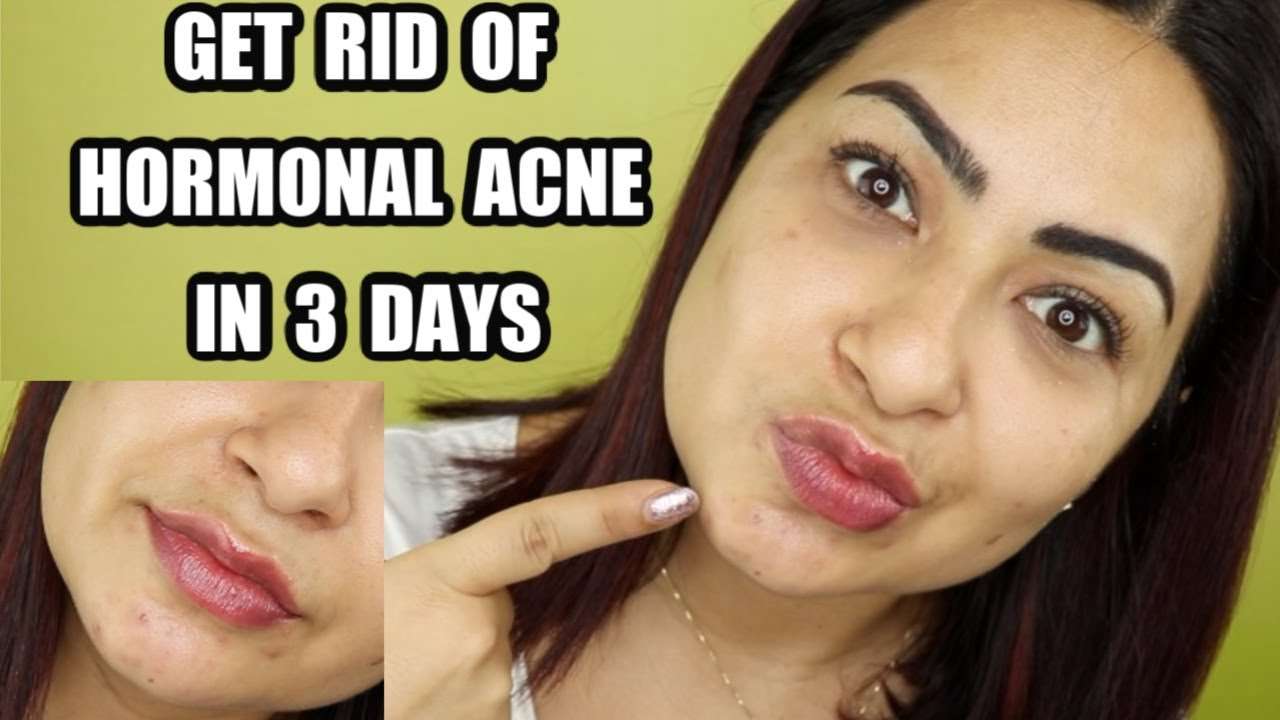 HOW TO GET RID OF HORMONAL ACNE IN 3 DAYS?