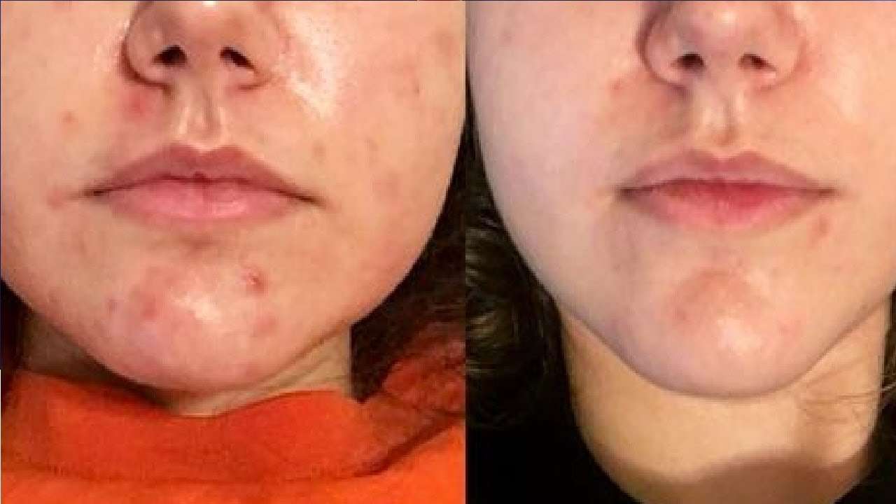 how to get rid of hormonal acne on chin