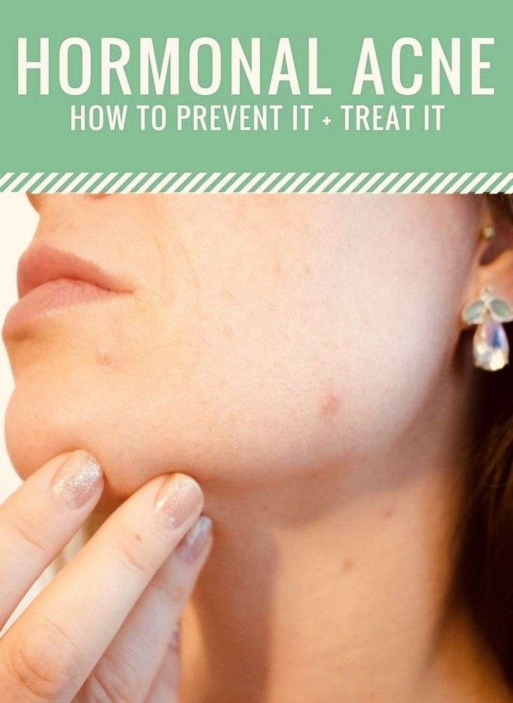 How to prevent hormonal acne ?