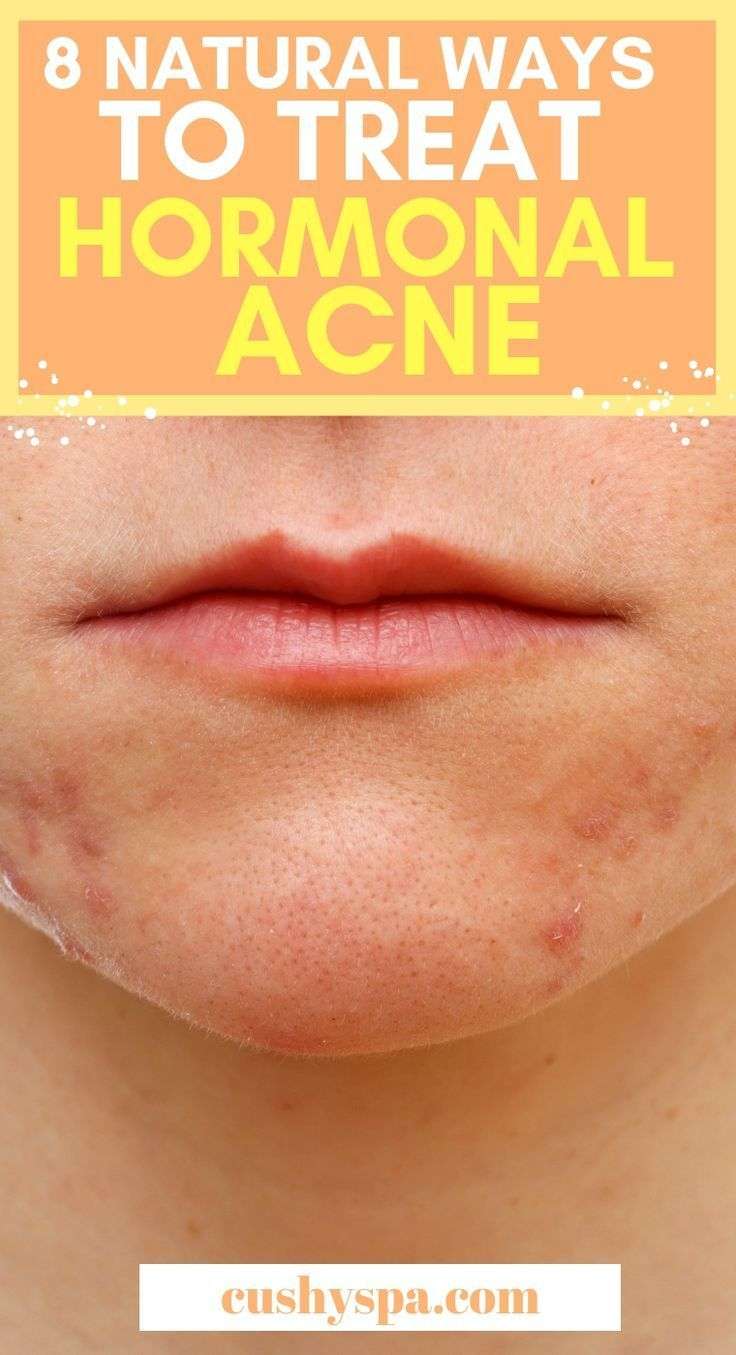 How to Treat Hormonal Acne Naturally: 8 Treatments ...