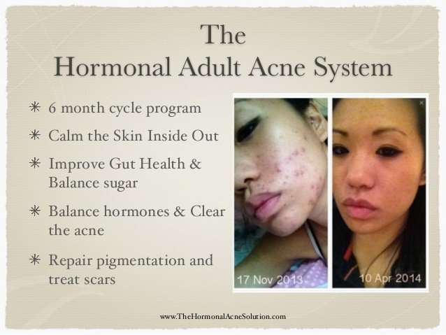 How To Treat Hormonal Acne On Chin Naturally Pictures ...