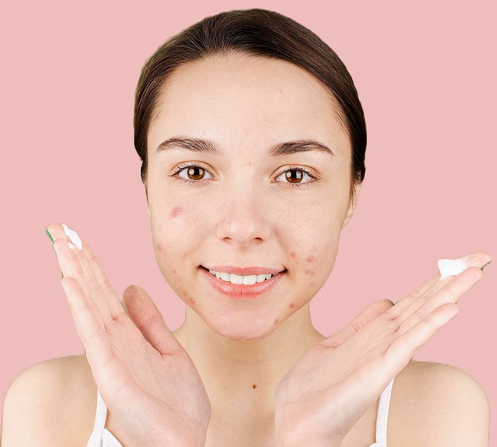 How to treat Hormonal Acne?
