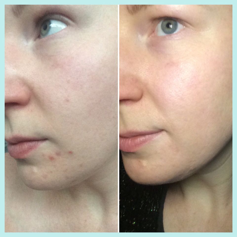" I always suffered from the odd hormonal breakout on the chin but ...