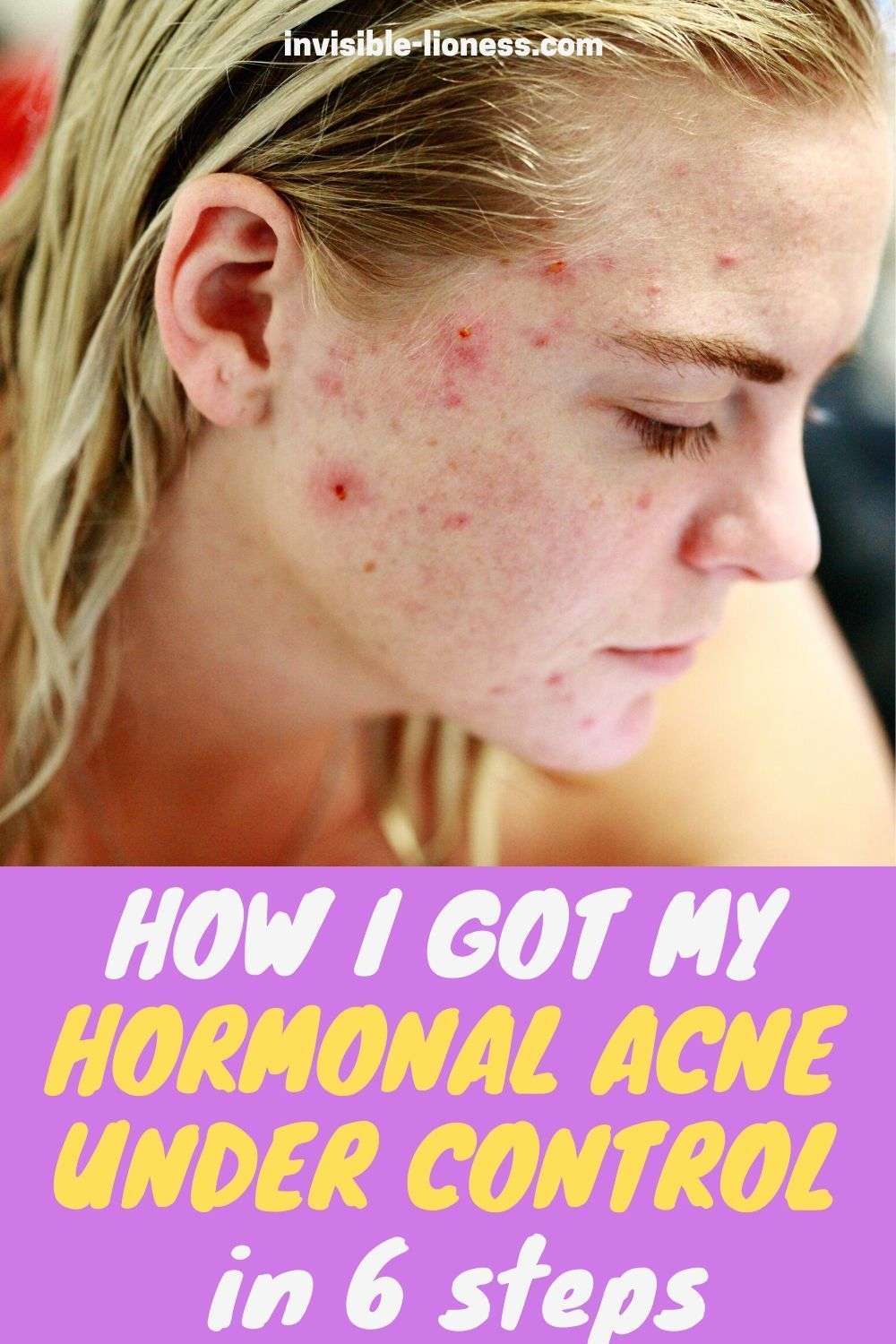 I beat hormonal acne: My 6 powerful little secrets ...