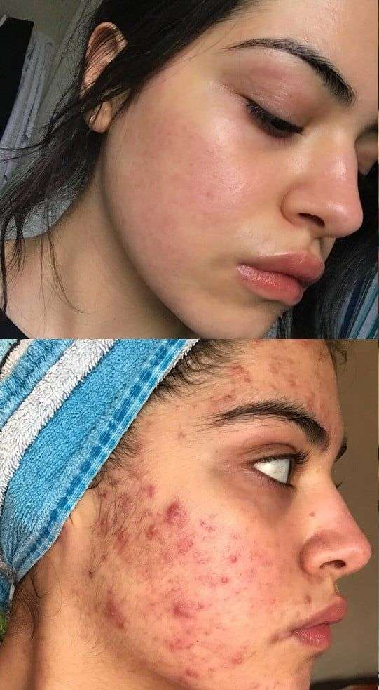 If You Suffer From Acne, These 6 Transformations May Give You Hope ...