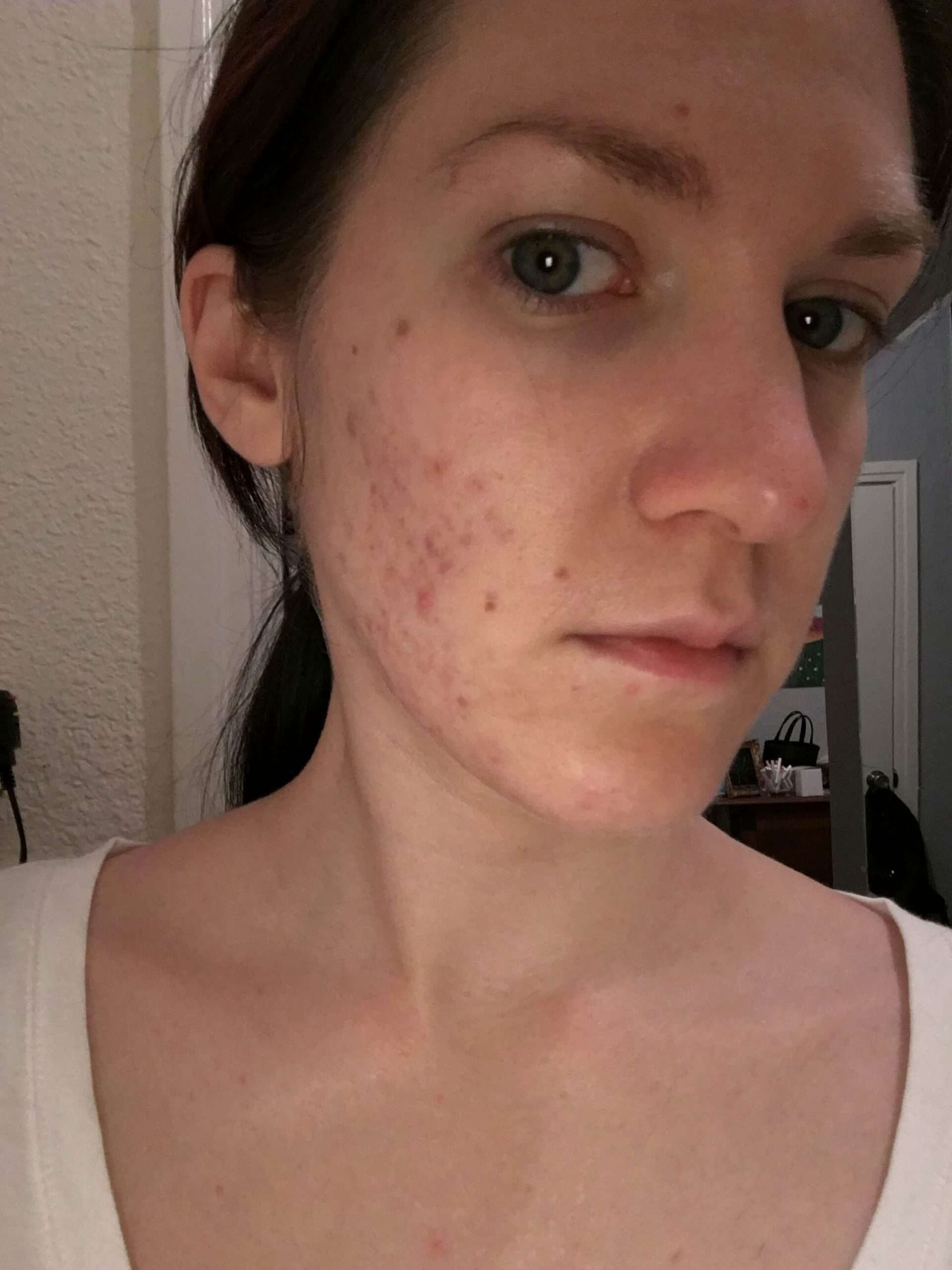 My Hormonal Acne Disappeared After Going Vegan  The Health Adventurer