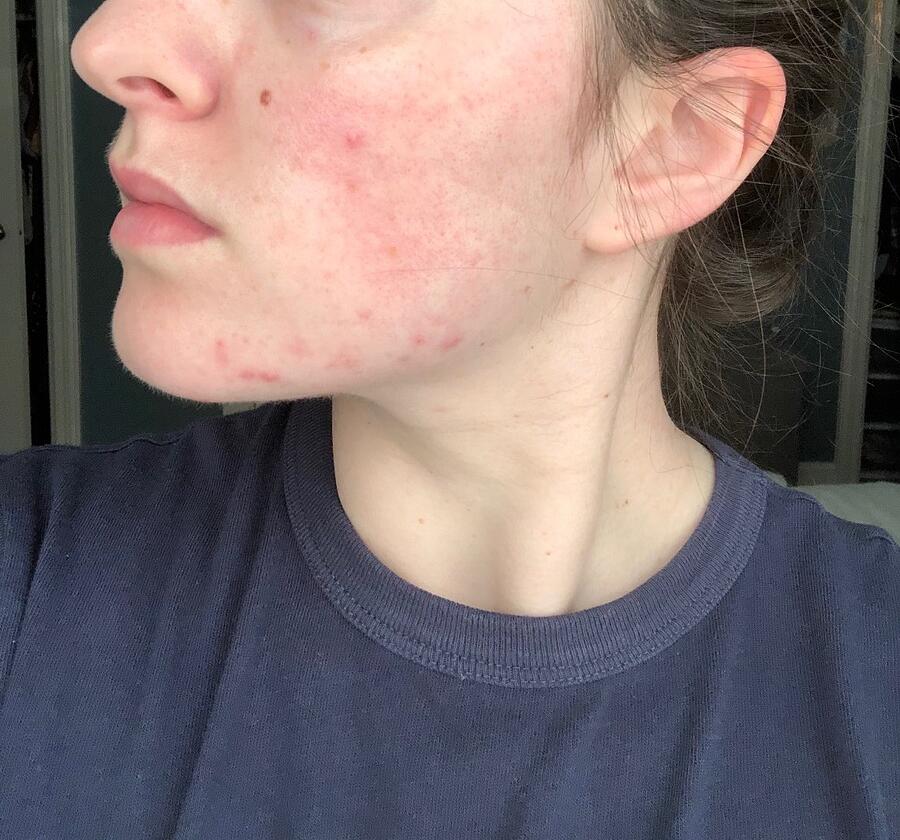 My Tretinoin Journey: How I Finally Cured My Hormonal Acne