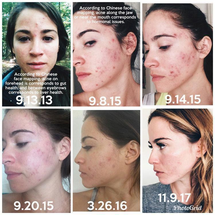 Nothing boosts confidence as effectively as the removal of acnes and ...