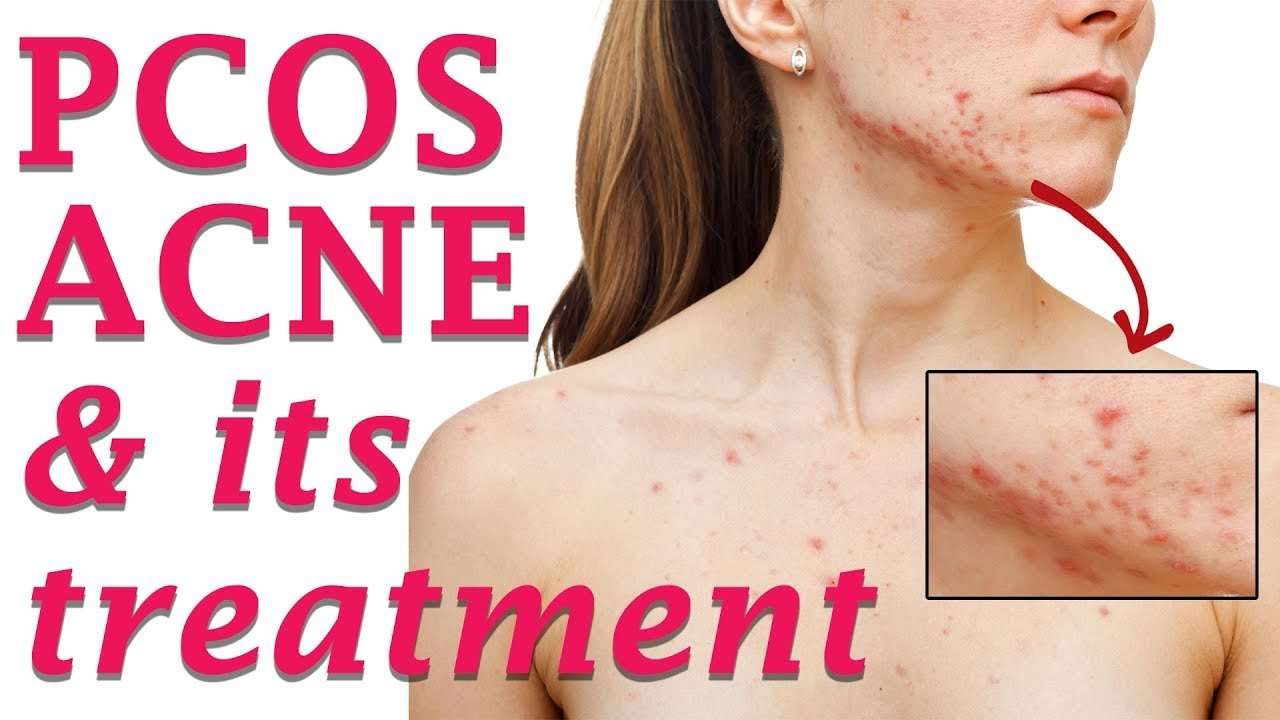 PCOS/ Hormonal Acne and its Treatment