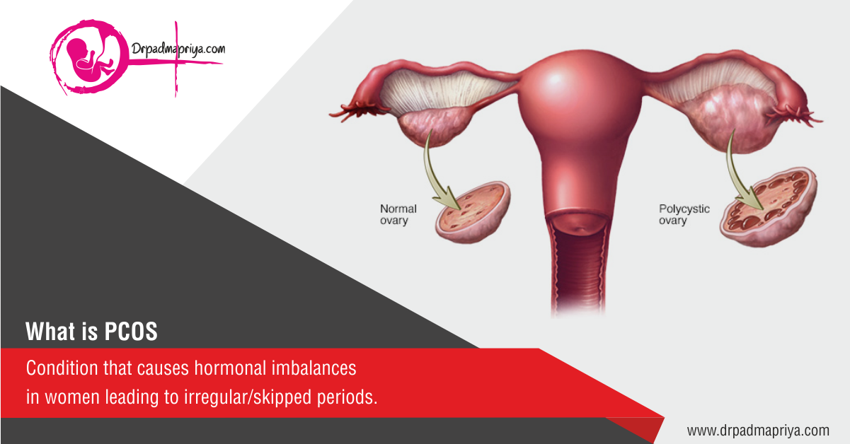 #PCOS is the Cause of Irregular Periods in #Women. Consult the doctor ...