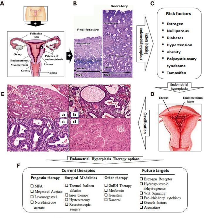 Pharmacotherapy of endometrial hyperplasion/Fertilitypedia