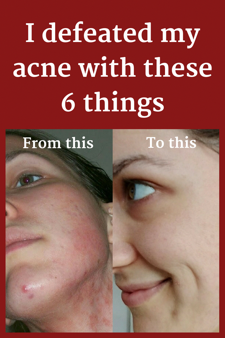 Pimples are mainly experienced by teens in their puberty ...