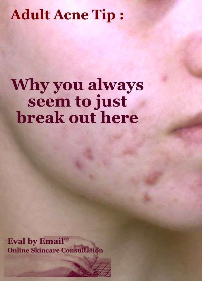 Pin on How To Get Rid Of Acne Overnight