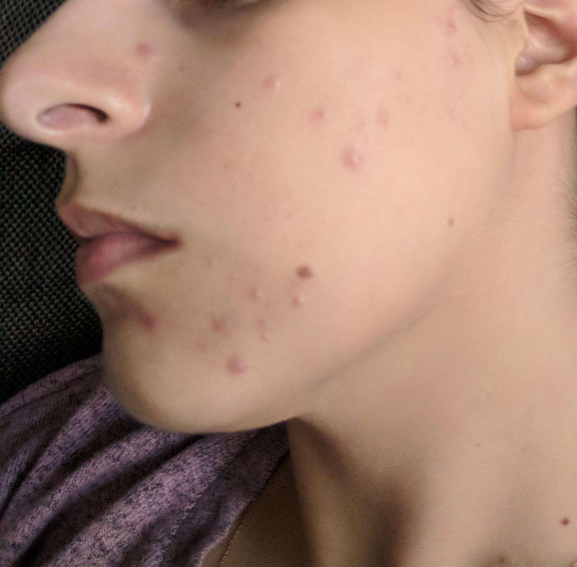 Please help. Dropping Proactiv+ and looking for advice on hormonal acne ...