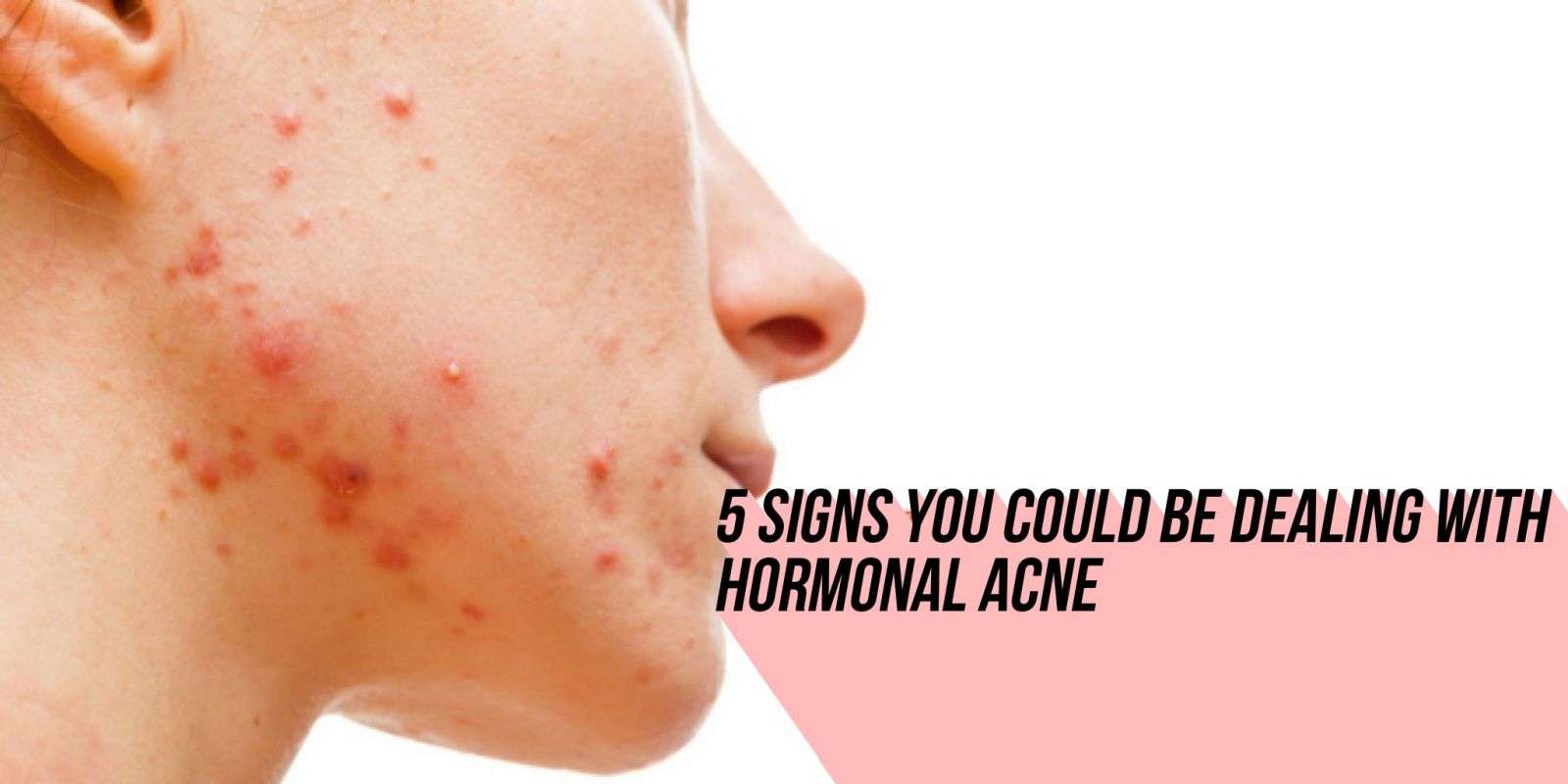 Signs That You Could Have Hormonal Acne, and Some Tips to ...