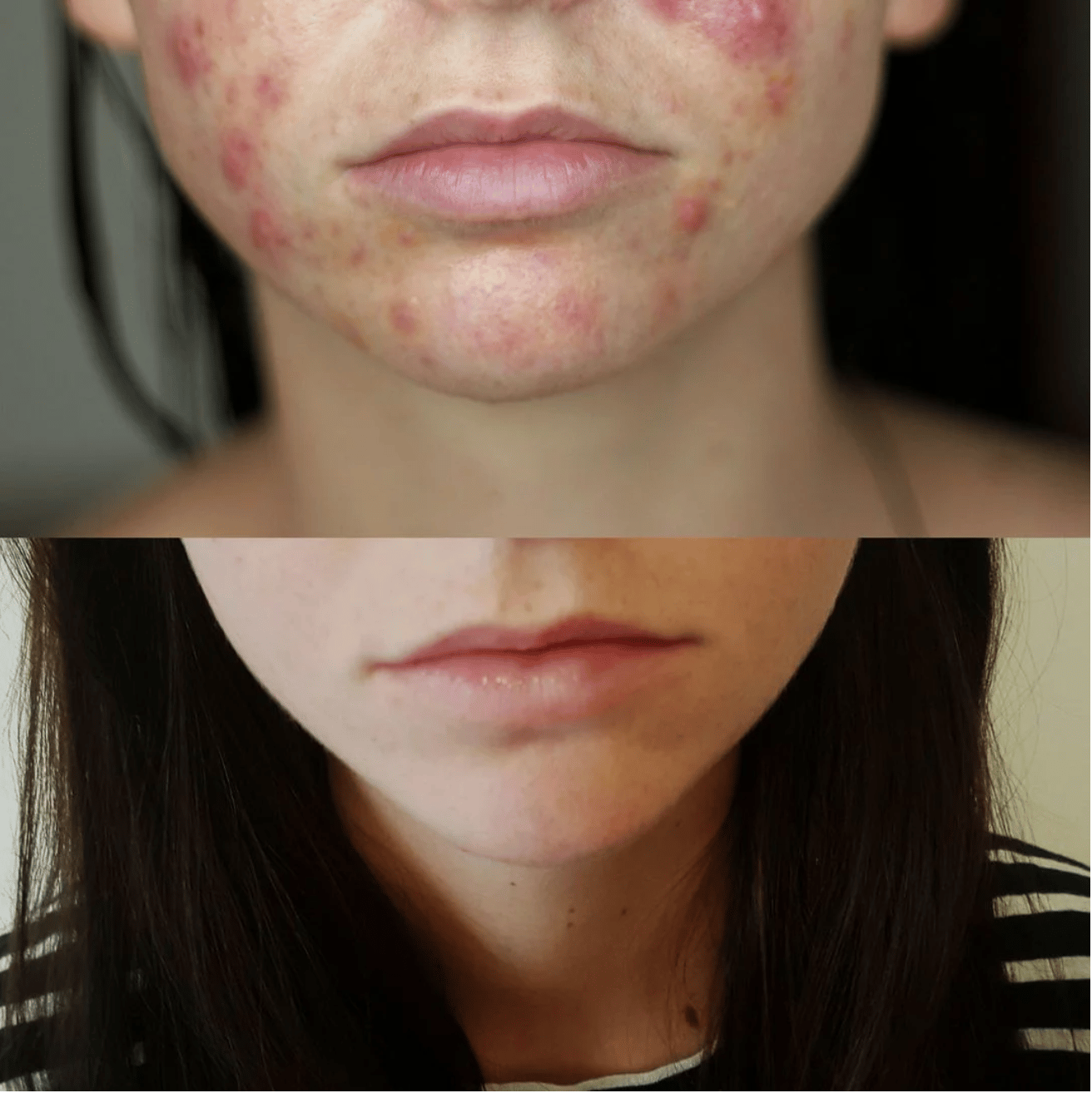 Spironolactone Clears Womans Acne in 4 Months: Before and After Photos ...