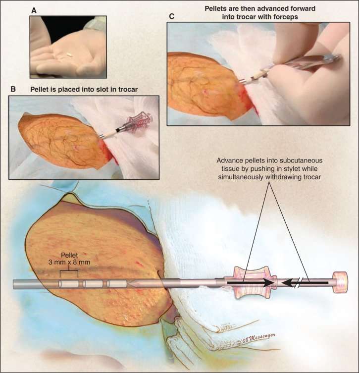 Subcutaneous Testosterone Pellet Implant (Testopel ...