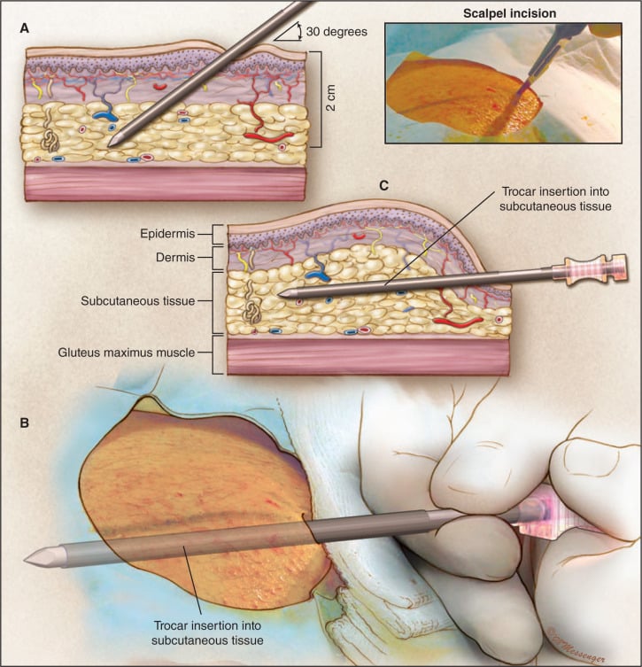 Subcutaneous Testosterone Pellet Implant (TestopelÂ®) Therapy for Men ...