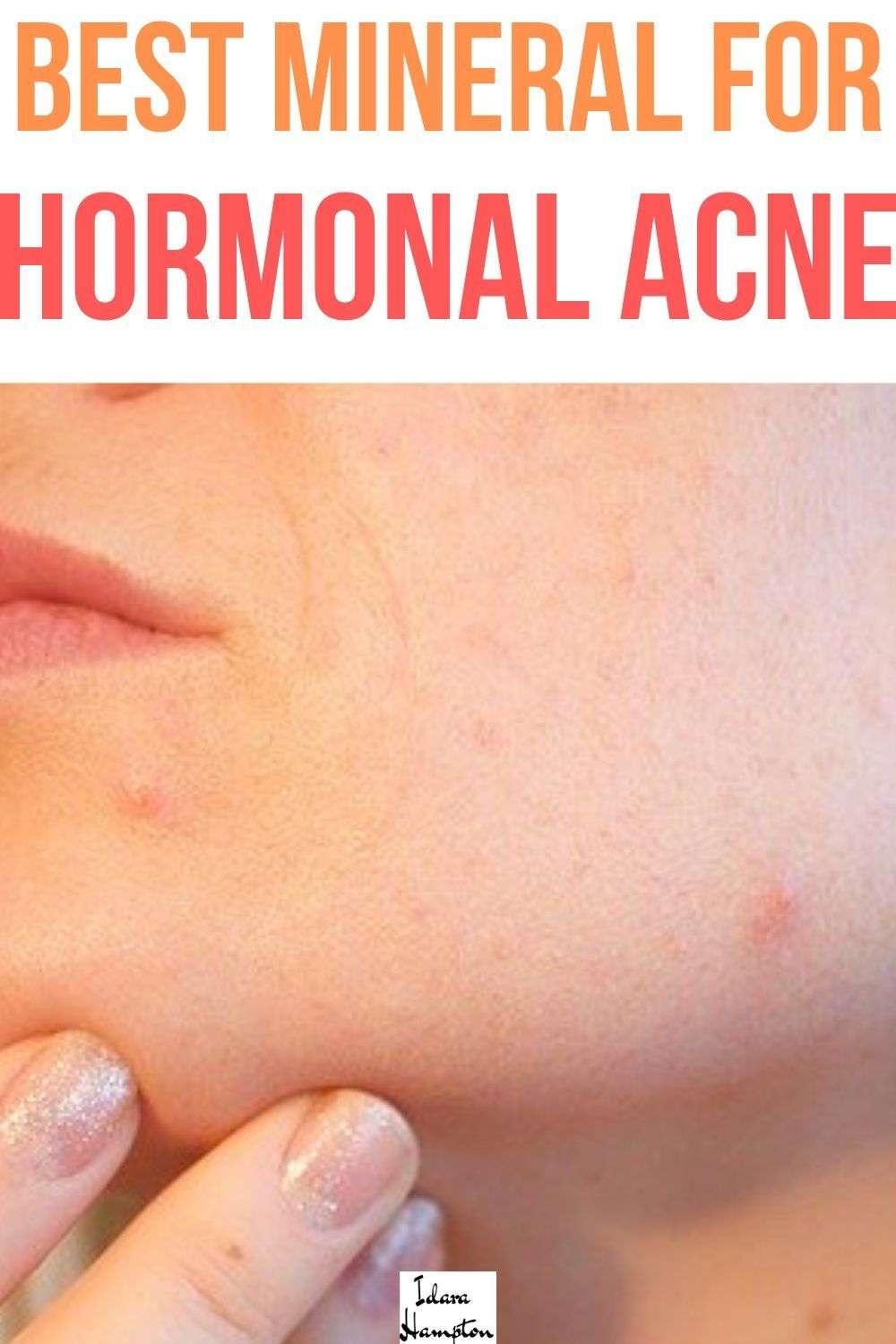 Supplement hormonal acne
