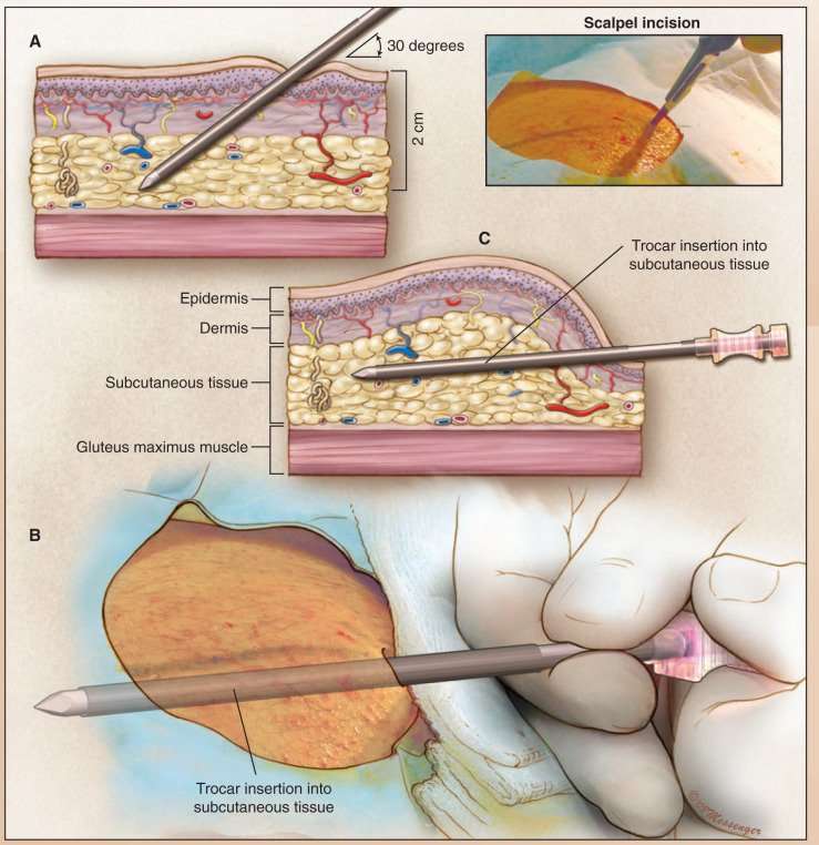 Surgical Techniques: Subcutaneous Testosterone Pellet ...