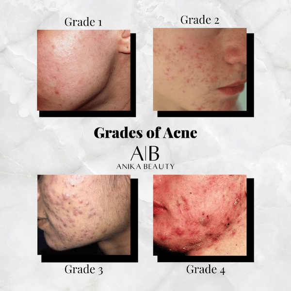 Teresa Paquin Acne and the different grades from one to four. How Can ...