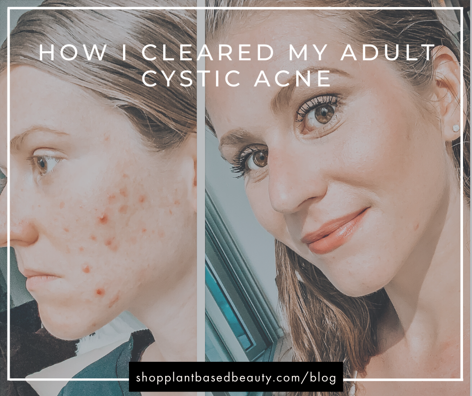 The complete guide to getting rid of cystic acne