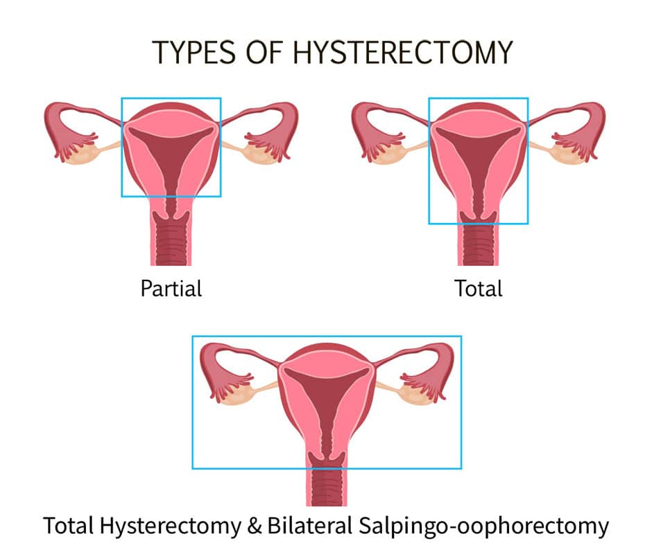 The Experts Weigh In: Is A Hysterectomy An Effective Endometriosis Tre ...