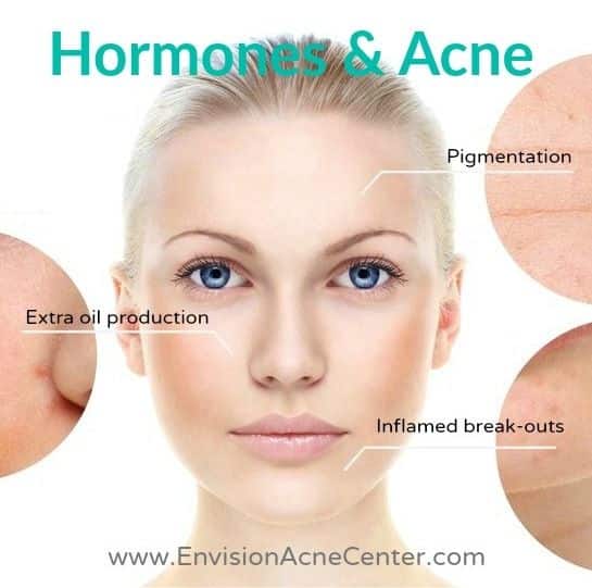 The primary cause of acne for middle aged women is hormones. Find out ...