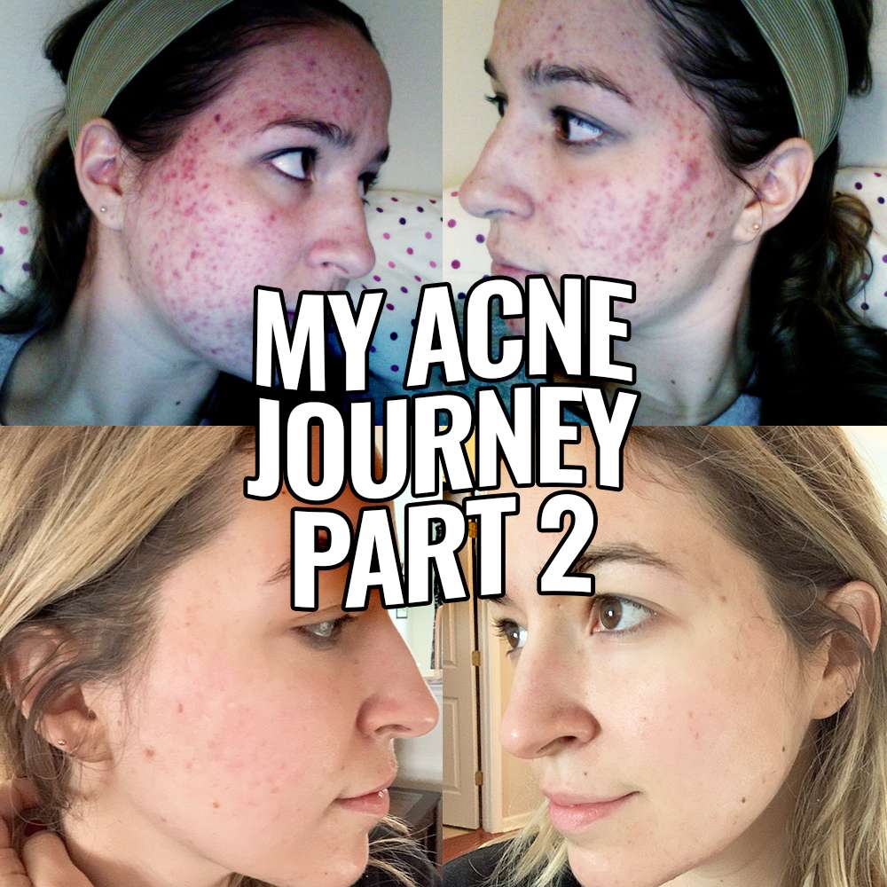 The Secret that Cleared My Severe, Hormonal, Cystic, Itchy, Adult Acne ...