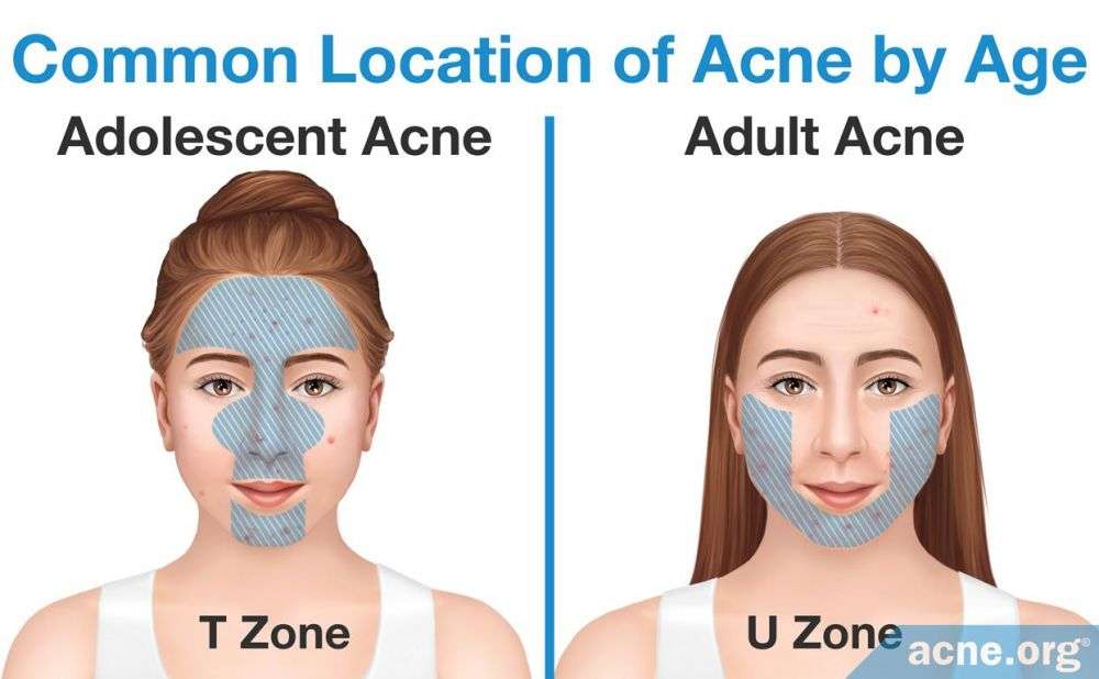 The Truth About "Chin Acne" In Women