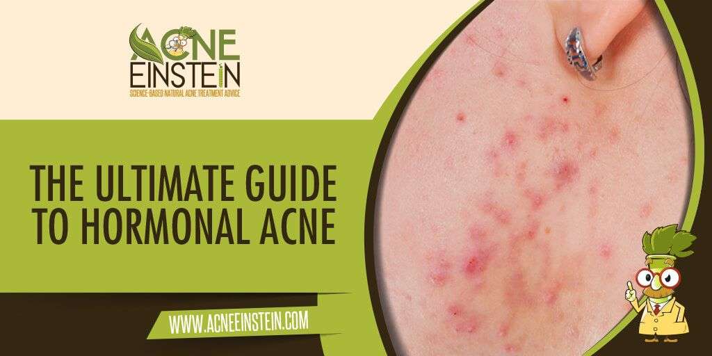The Ultimate Guide to Hormonal Acne