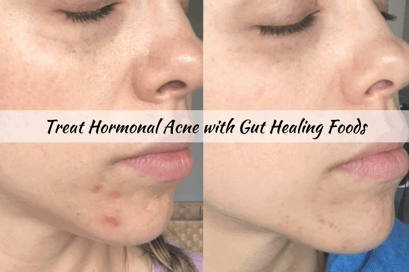Treat Hormonal Acne with Gut Healing Foods