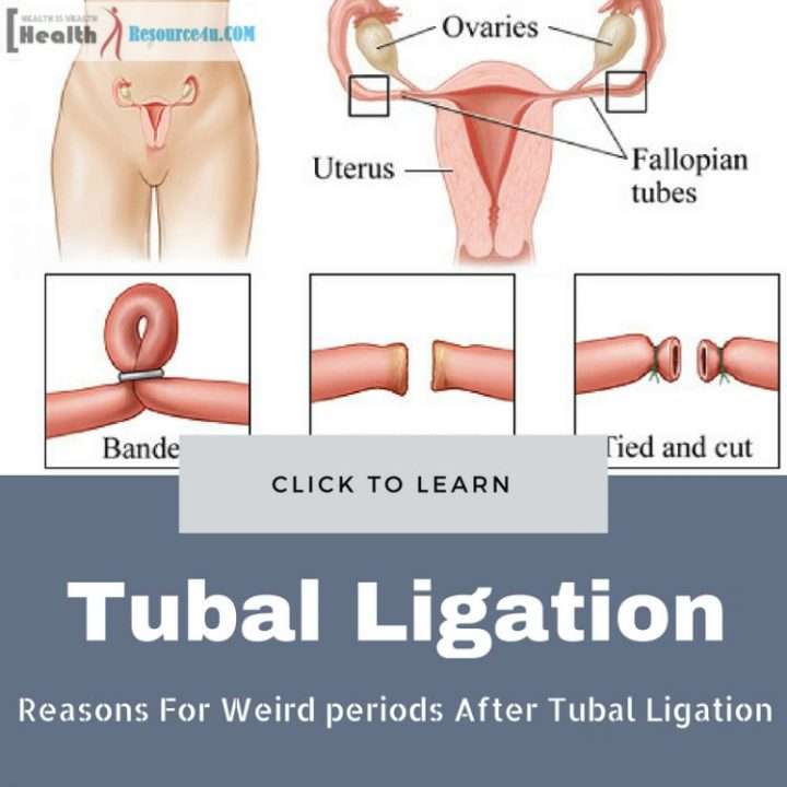 Tubal Ligation Side Effects Weight Gain