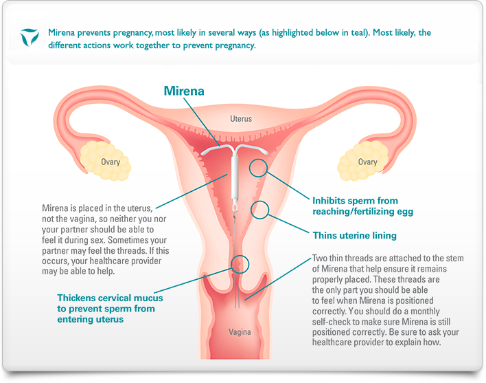 Using a Mirena for Birth Control