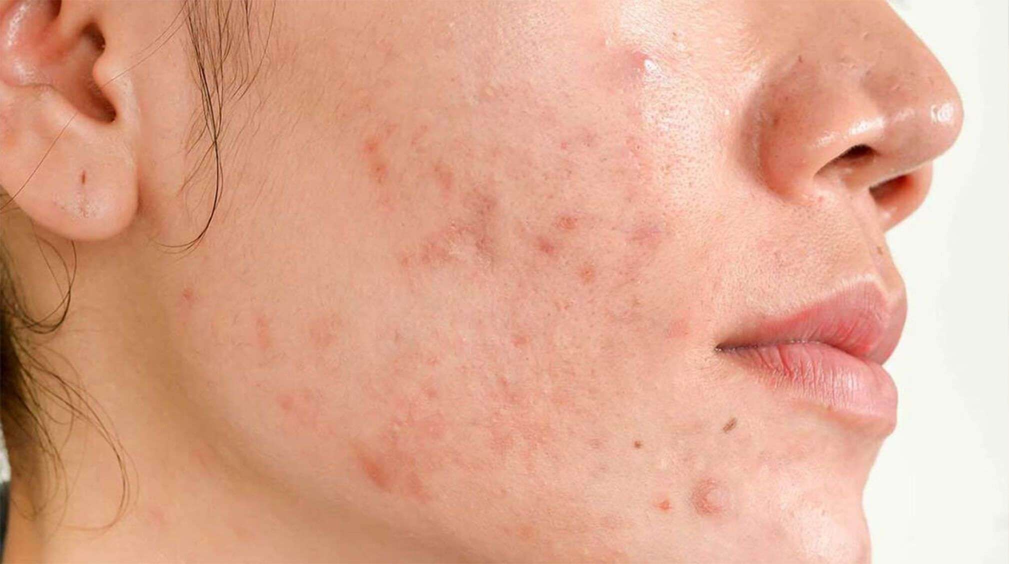 What Causes Hormonal Acne?