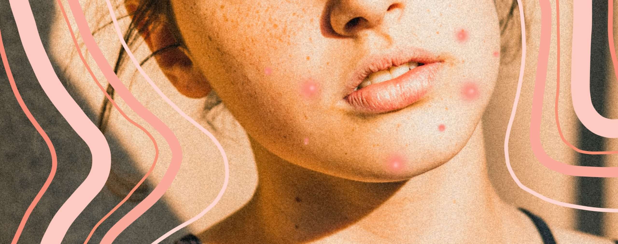 What is Hormonal Acne and How Do You Treat It?